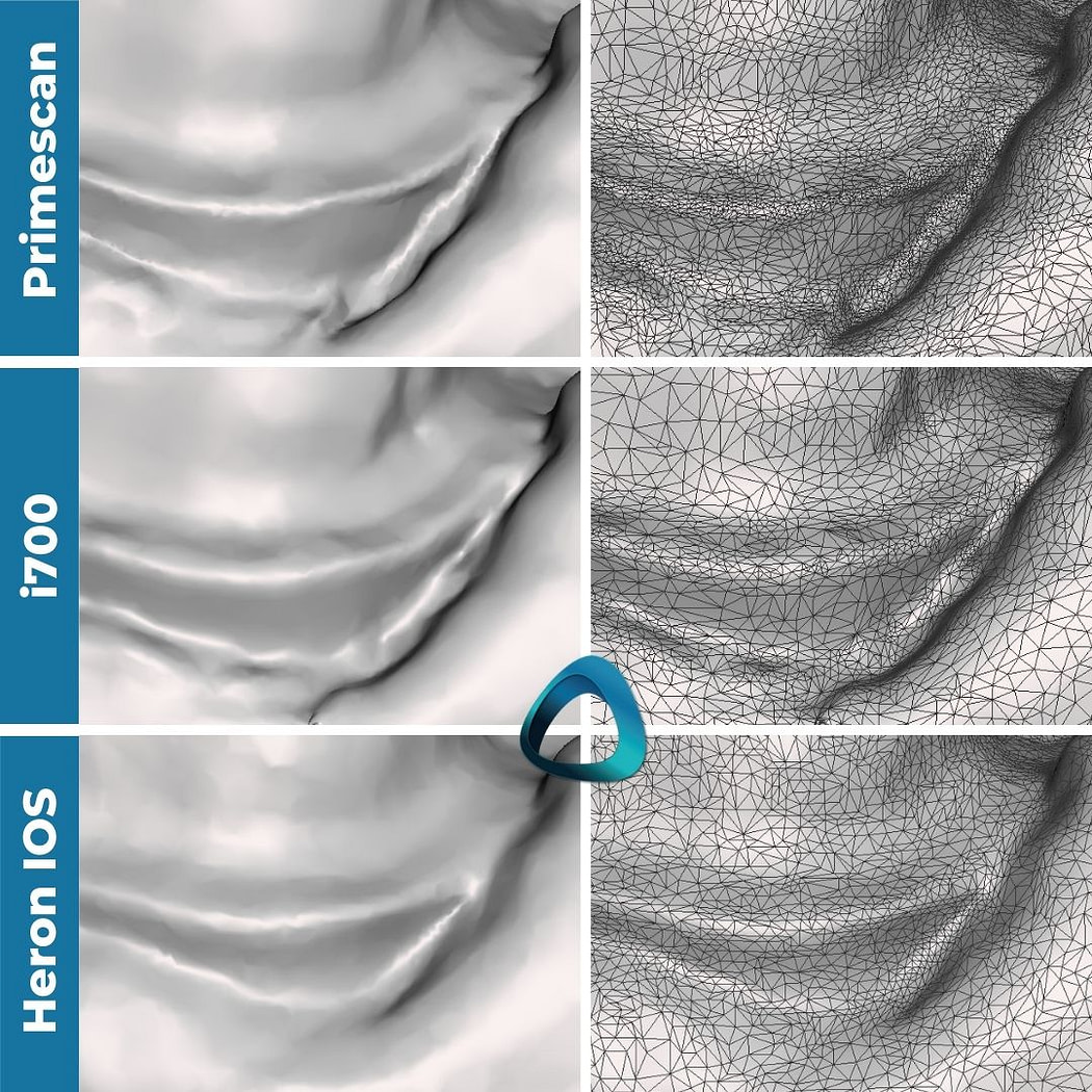 07-close-up-of-the-margin-monochrome-and-tessellated-mesh-idd-compares-intraoral-scanners-expensive-vs-cheap-compared-cerec-primescan-vs-medit-i700-vs-heron-ios