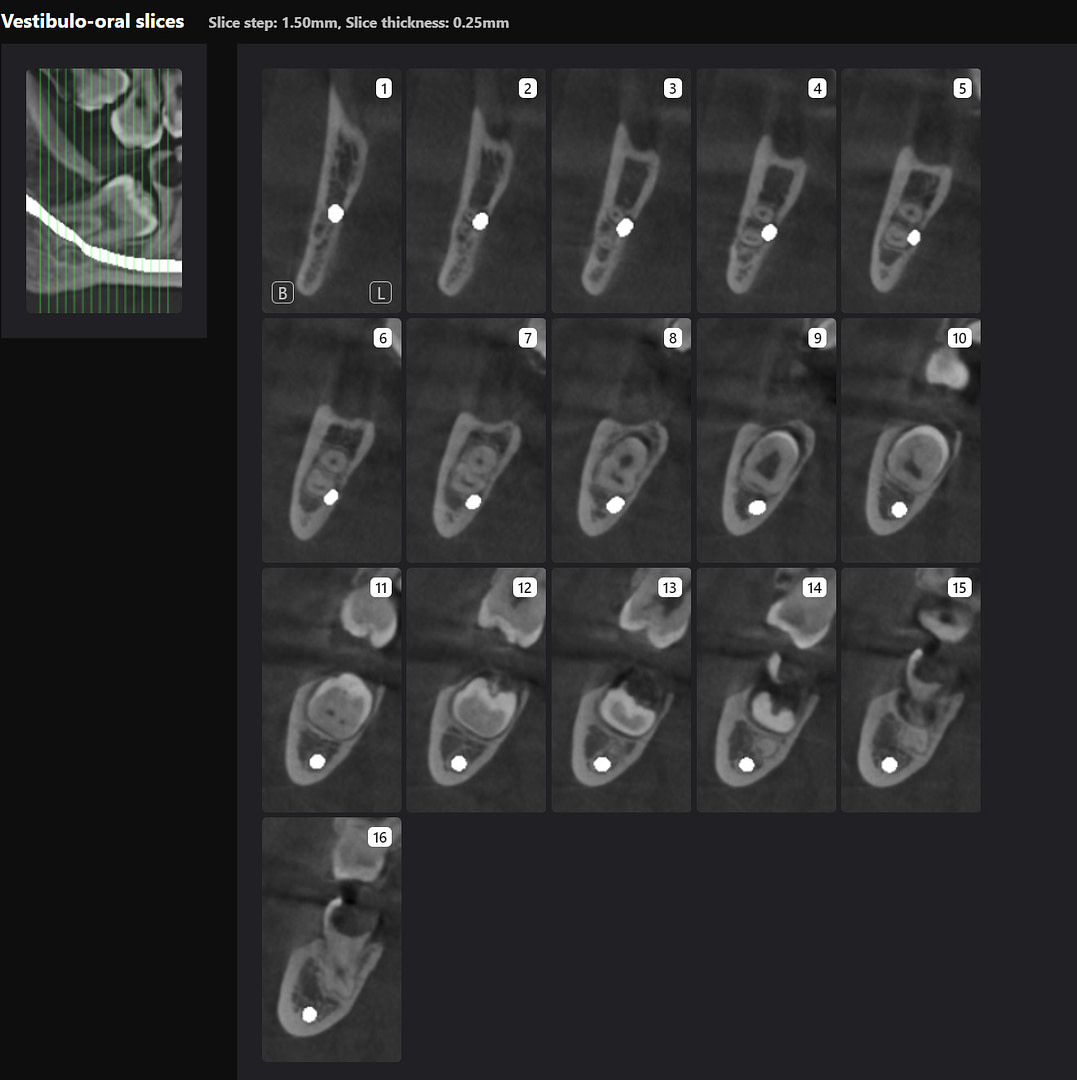 Third Molar Slices 1