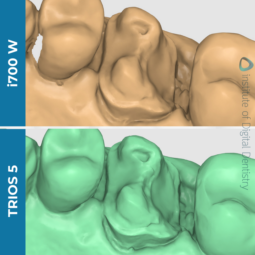 medit-i700w-3shape-trios5-intraoral-scanner-idd-compares-margin-prep-line-stl-scan
