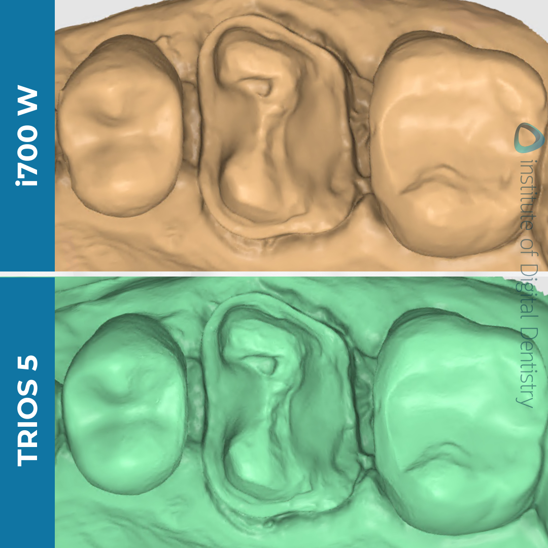 medit-i700w-3shape-trios5-intraoral-scanner-idd-compares-stl-medit-design-scans