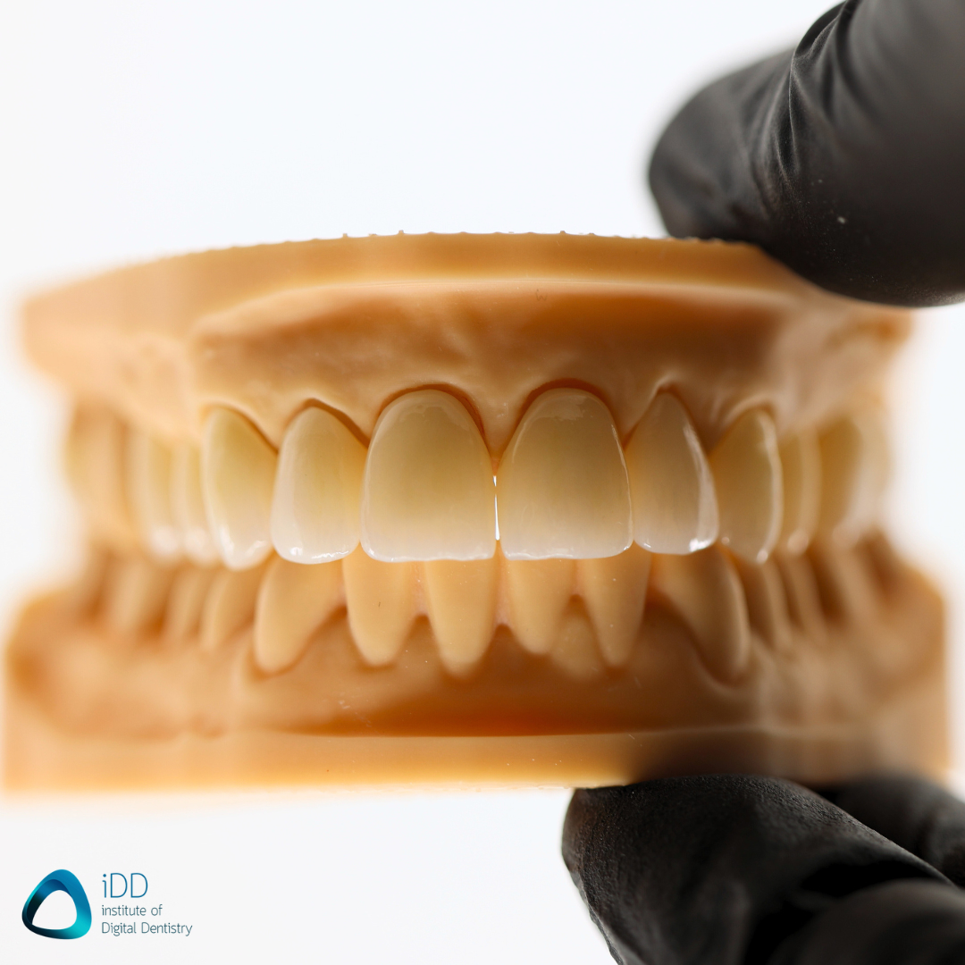 idd-clinical-case-digital-dental-full-mouth-rehabilitation-workflow-upper-final-zirconia-crown-restorations