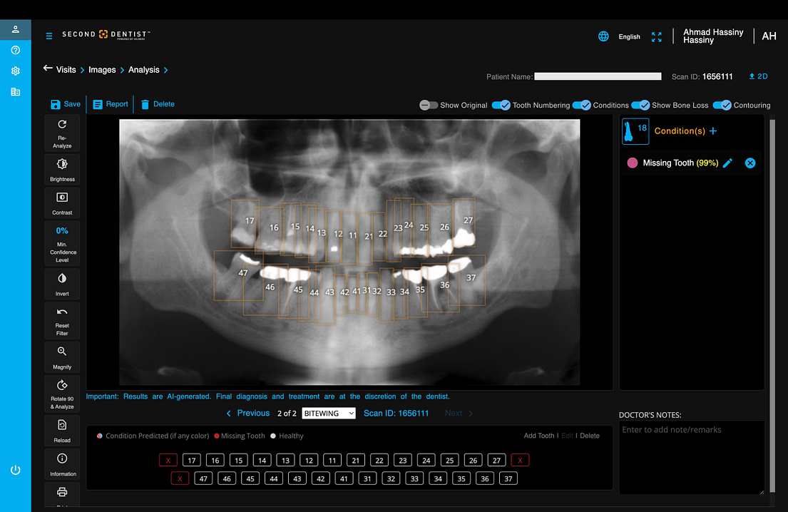 velmeni-second-dentist-ai-review-blog-idd-institute-of-digital-dentistry-software-patient-missing-tooth