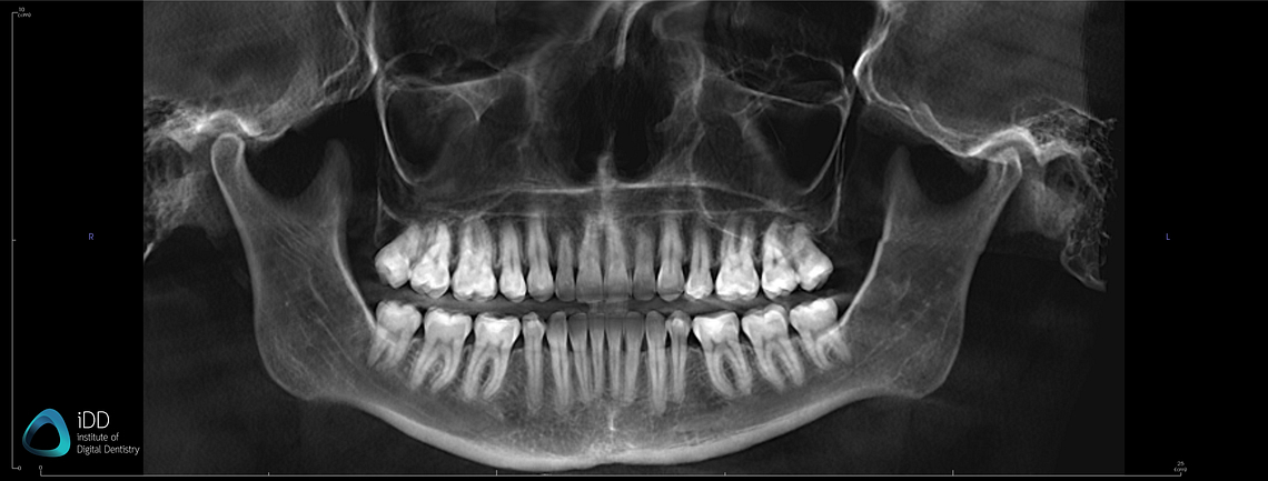 iDD-cbct-image-panoramic-patient-scan