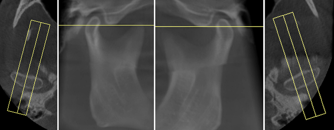 TMJ Saggital Summation