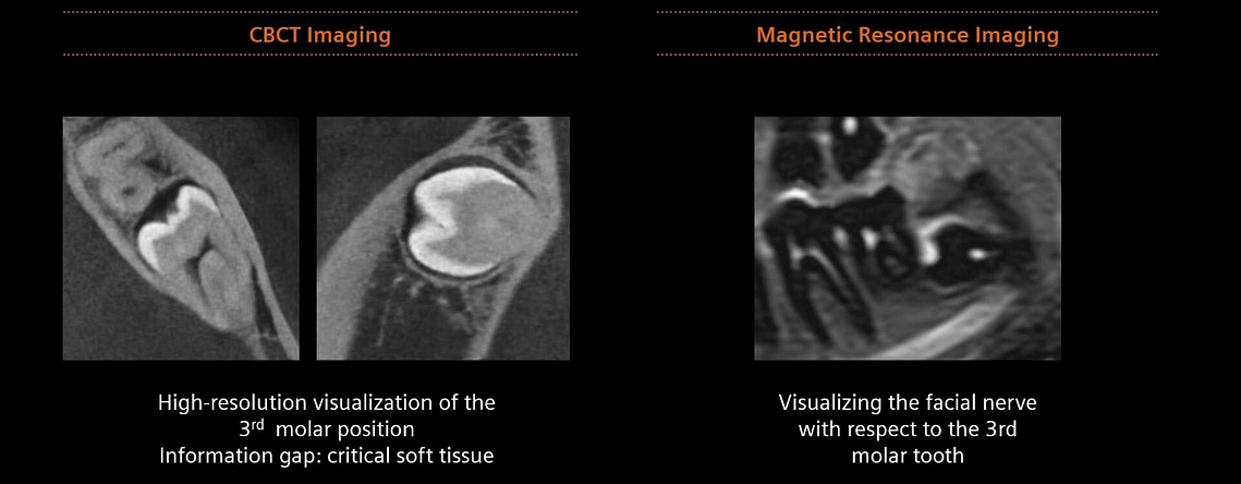clinical-image-siemens-healthineers-dental-mri-Clinical-Evidence-3rd-Molar-idd-blog