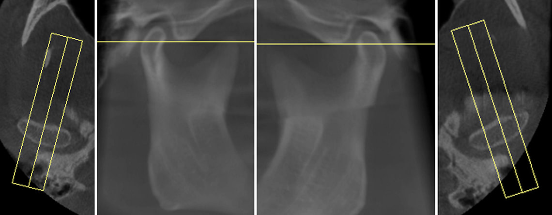 TMJ Saggital Summation