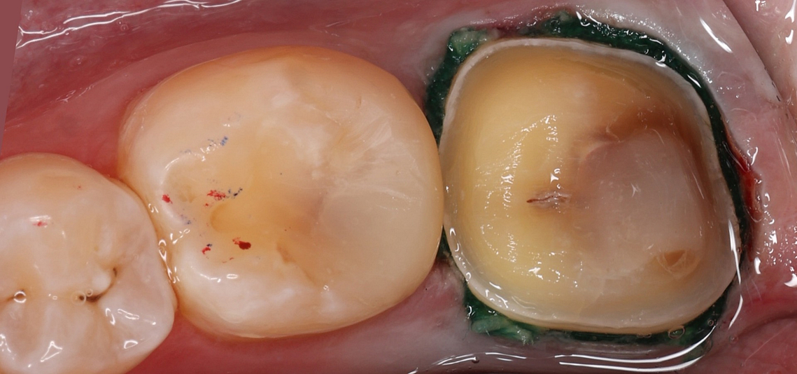 14 - Medit Innovation Day 2023 Presentation Single-Visit Restorations Using Medit ClinicCAD Ahmad Al-Hassiny - Slide14