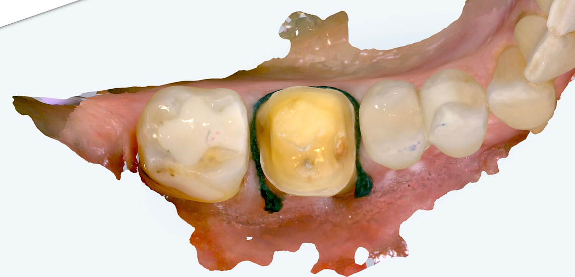 itero_design_suite_Lumina_iDD1