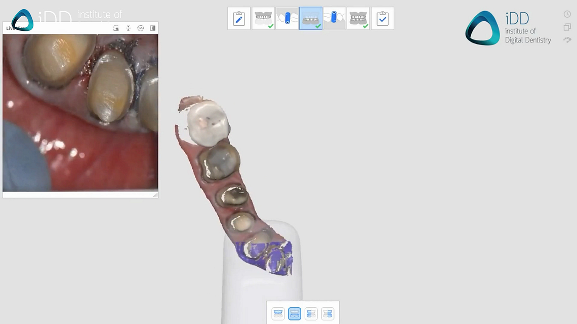 idd-3d-printing-dental-crowns-intraoral-scanning-prep