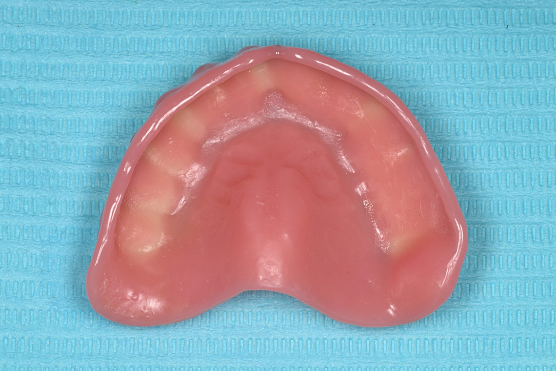 rodin-soft-reline-kit-3d-printed-dentures-workflow-blog-idd-institute-of-digital-dentistry-upper-denture-clean-intaglio-surface-application