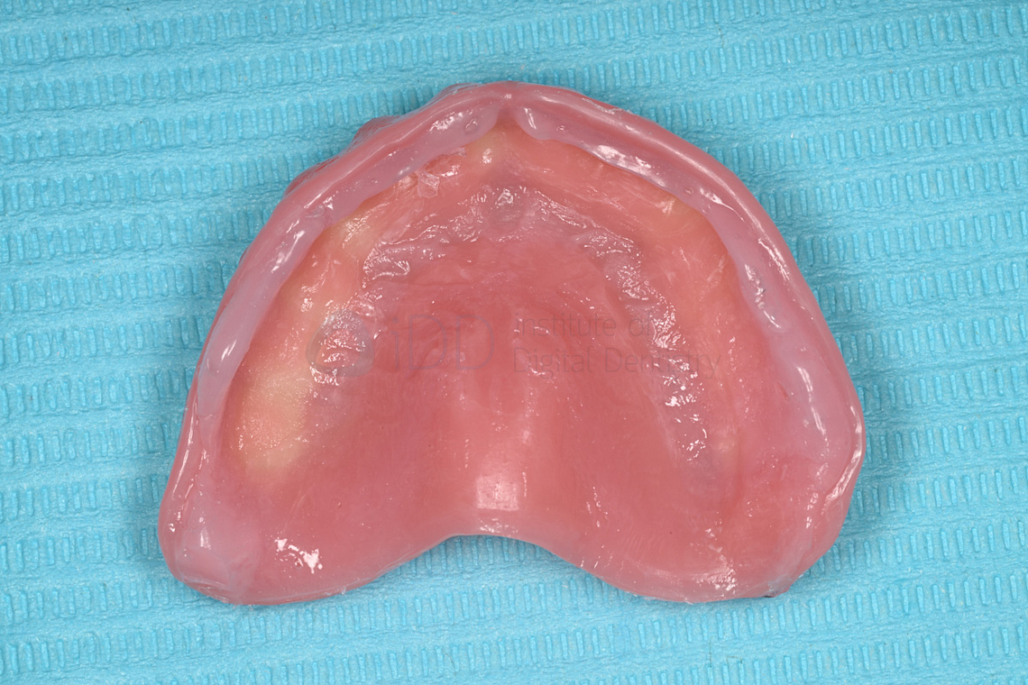 rodin-soft-reline-kit-3d-printed-dentures-workflow-blog-idd-institute-of-digital-dentistry-upper-denture-soft-reline-material-intaglio-surface-application