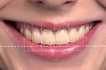 How to do Digital Smile Design Course