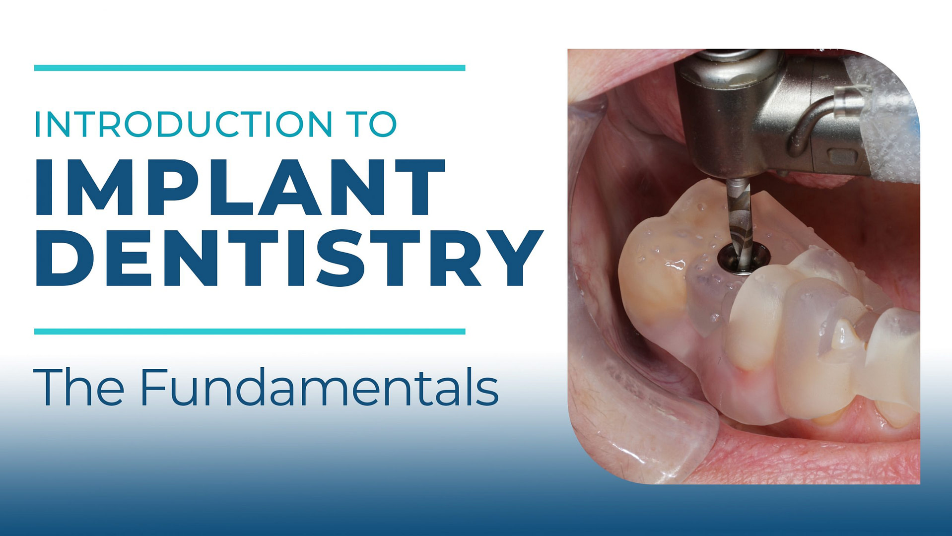 Introduction To Implant Dentistry - The Fundamentals | Institute