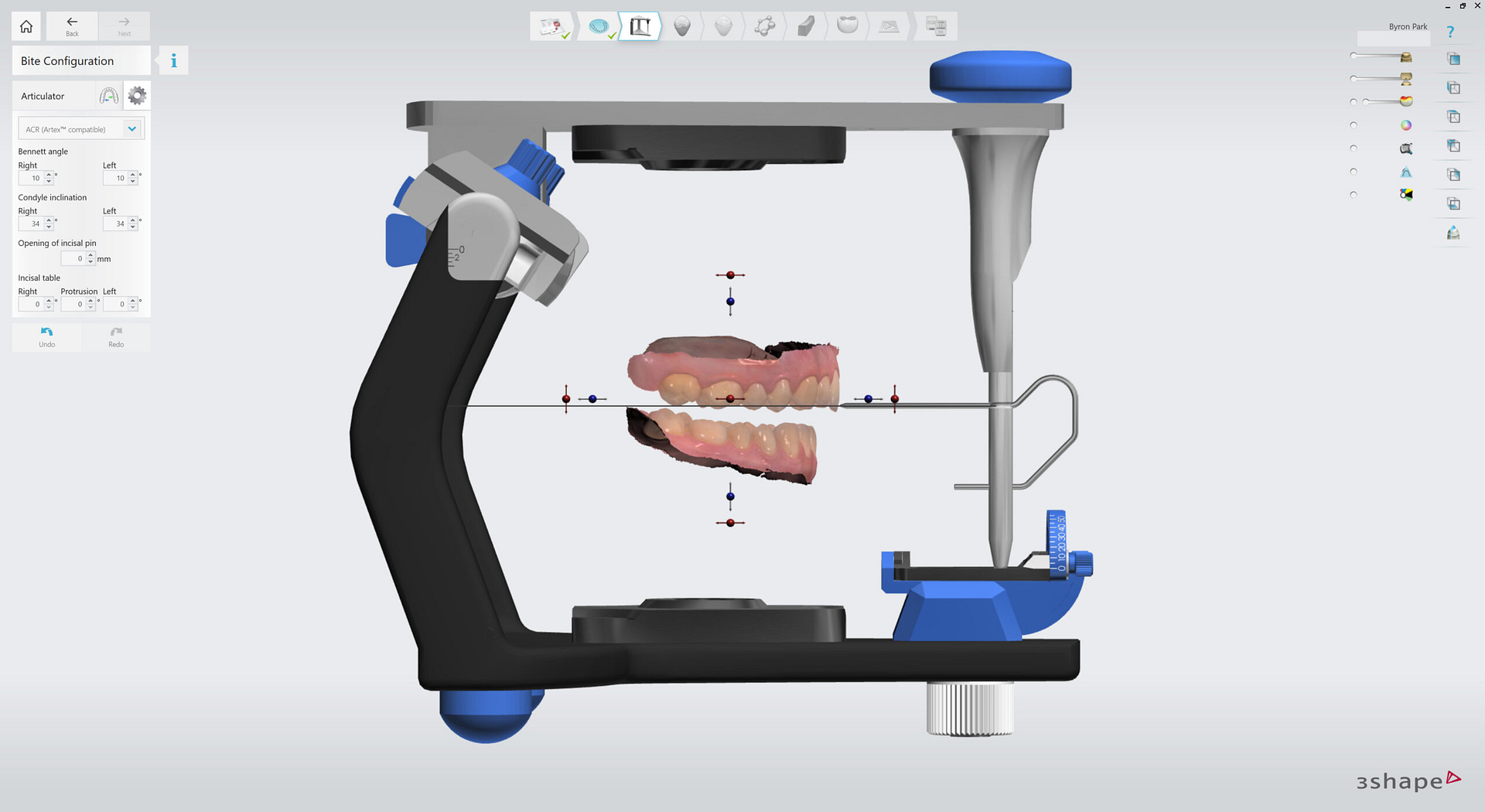 3shape-intraoral-trios-scan-bite-splint-idd-institute-of-digital-dentistry-blog-byron-park-splint-studio-virtual-articulator-simulate-movements