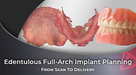 From Scan To Delivery Edentulous Full-Arch Implant Planning