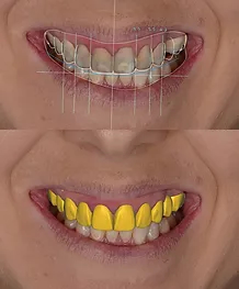 Smile Design