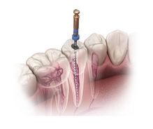 Implant Restorations