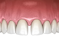 Gapped teeth