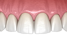 Gummy smiles or uneven gum lines