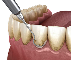Discolored or stained teeth