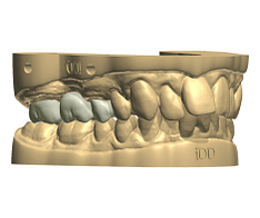Crowns, bridges, and veneers