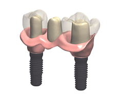 Dental implant restorations