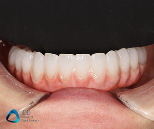 Full arch implant