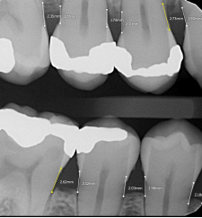 bone-measurement-white-line-yellow-line-pearl-ai-second-opinion-idd-institute-of-digital-dentistry-blog