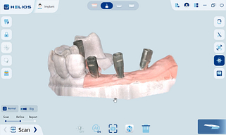intraoral implant scan