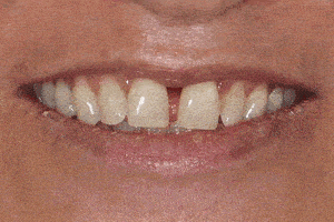 crown-before-and-after