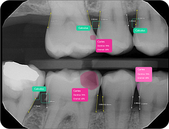 calculus-caries-bone-measurement-pearl-ai-second-opinion-idd-institute-of-digital-dentistry-blog