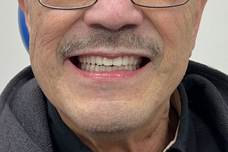 Transitioning to Full Digital Dentures using 3Shape Dental System (2)