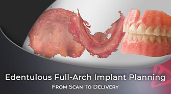 From Scan To Delivery Edentulous Full-Arch Implant Planning