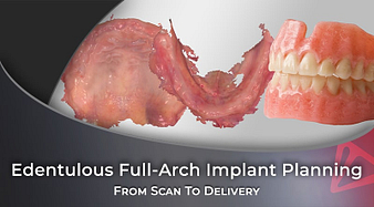 From Scan To Delivery Edentulous Full-Arch Implant Planning