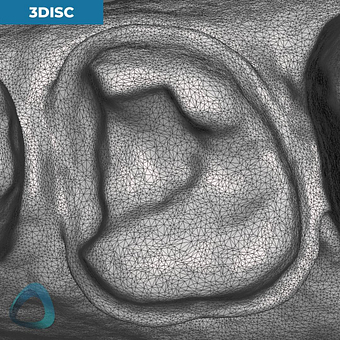 tooth-preparation-scan-with-3disc-heron-ios