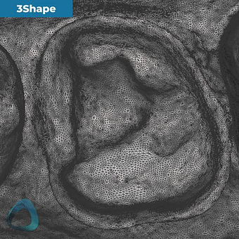 tooth-preparation-scan-with-3shape-trios-4