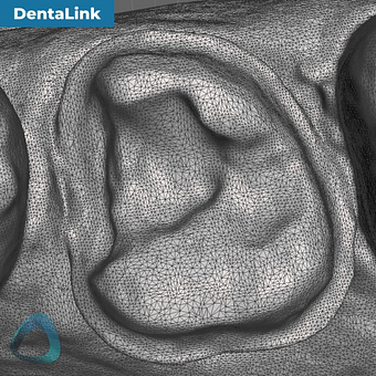 tooth-preparation-scan-with-dentalink-s6000