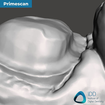 08-primescan-close-up-of-the-margin-idd-compares-intraoral-scanners-expensive-vs-cheap-compared-cerec-primescan-vs-medit-i700-vs-heron-ios