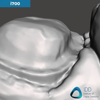 09-medit-i700-close-up-of-the-margin-idd-compares-intraoral-scanners-expensive-vs-cheap-compared-cerec-primescan-vs-medit-i700-vs-heron-ios