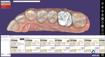 exocad crown workflow institute of digital dentistry (3)