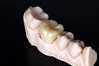 3D printed crown restoration digital dentistry