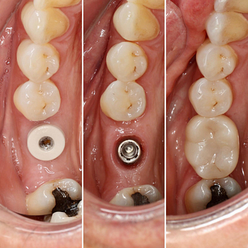 dental implant course institute of digital dentistry