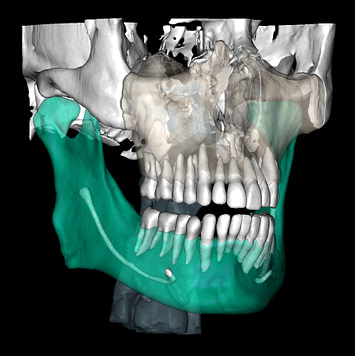 CBCT STL 2