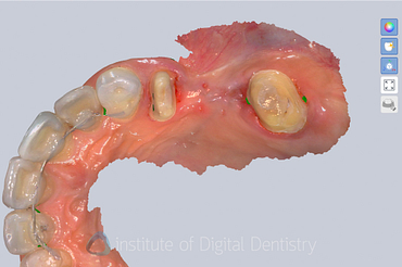 alliedstar_sensa_intraoral_scanner_review_iDD (11)