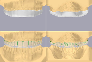 3shape-ai-automate-artificial-intelligence-idd-institute-of-digital-dentistry-blog