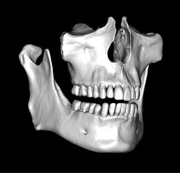 CBCT STL 3