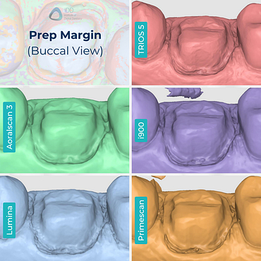 medit-i900-itero-lumina-cerec-primescan-3shape-trios-5-shining-3d-aoralscan-3-intraoral-scanner-idd-compares-institute-of-digital-dentistry-medit-design-prep-margin-buccal-view-scan