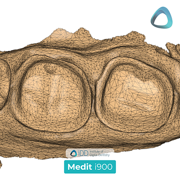 medit-i900-idd-compares-institute-of-digital-dentistry-blog-medit-design-software-app-prep-tessellation-mesh-density-accuracy-scan