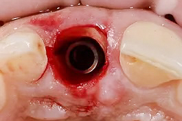 Partial Extraction Therapy (PET)2