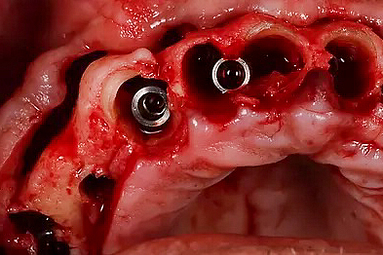 Partial Extraction Therapy (PET)4